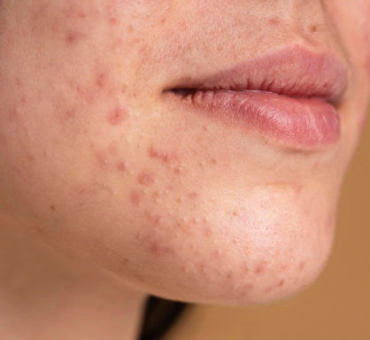 Acne-prone