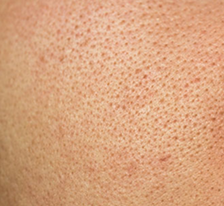 ENLARGED PORES