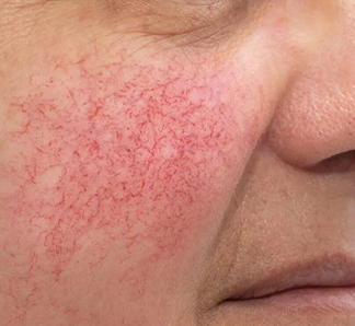 REDNESS PRONE