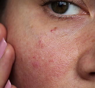SENSITIVE SKIN