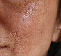 Discoloration