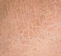 Dry skin