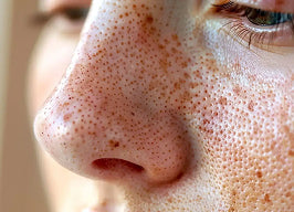 Enlarged pores