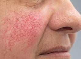 Redness-prone