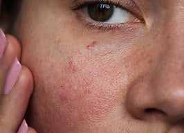 Sensitive skin